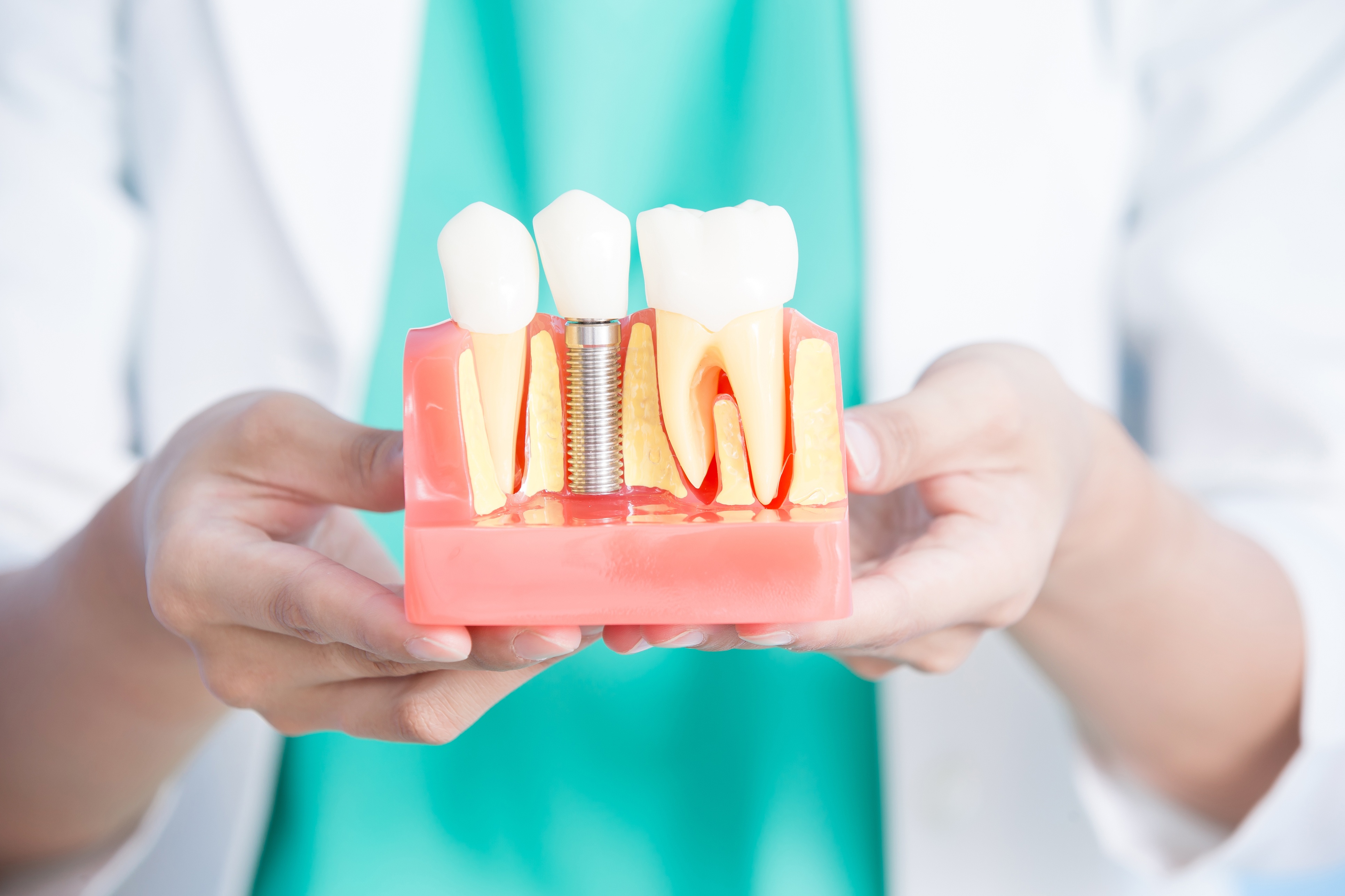 Dental Implants Get to Know the Basics